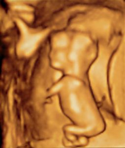 3 1/2 Month Fetus
